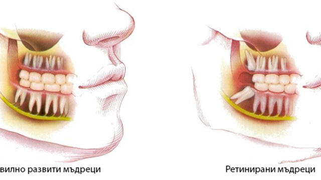 При хирург зъболекар -  Екстракция /вадене/ на ретиниран мъдрец - 18+ *