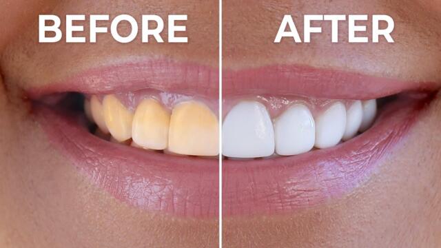 Instant Teeth Whitening At Home | How To Naturally Whiten Yellow Teeth