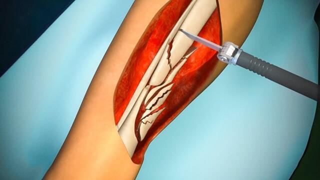 HOW LEG BONE SURGERIES ARE DONE