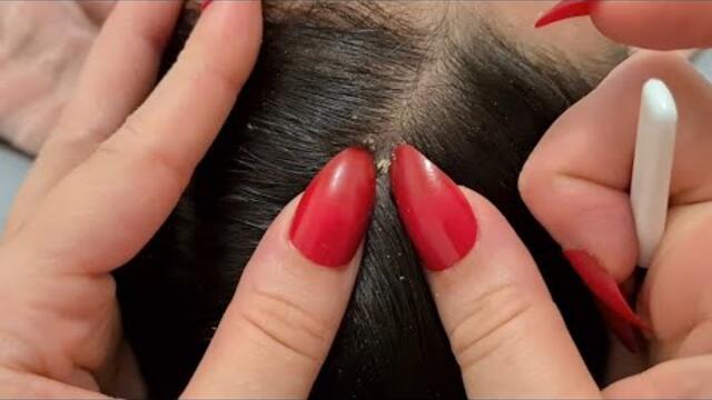 ASMR- 15 TRIGGERS Scalp Scratching for SLEEP😴 #forsleep #scalp #triggers #relaxing