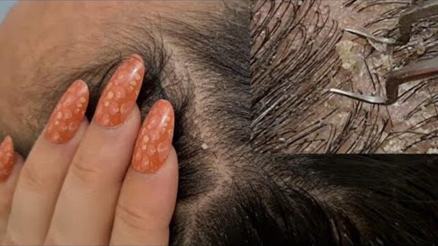 ASMR- Scalp Check ~ Scratching ~Long nails, Tweezers, Brush...ZOOM×5