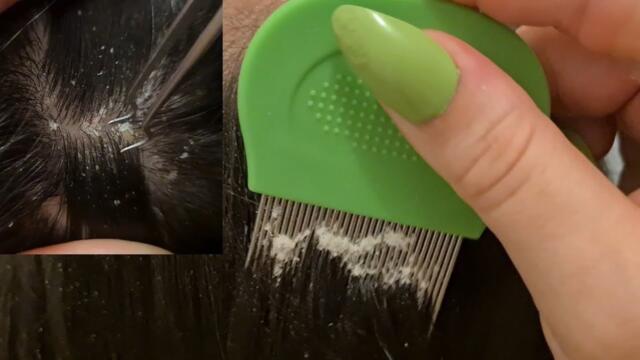 ASMR- Relaxing scalp check for sleep / ZOOM #scratching #longnails #asmrsleep #scalp #tweezers