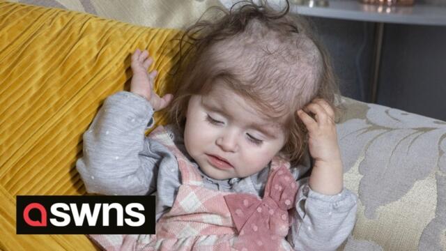 Toddler is having hair shaved off for her own safety after being diagnosed with condition which only impacts 50 children around the world