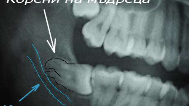 Откриване и изваждане на ретиниран мъдрец! Extraction of horizontal Lt. Mn third molar