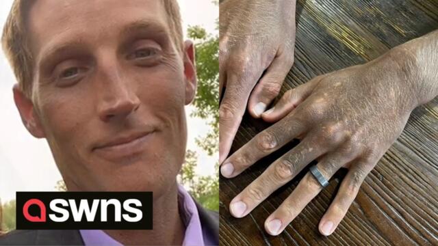 US man is 'medical mystery' after anti-depressant drug changes skin colour from white to dark grey