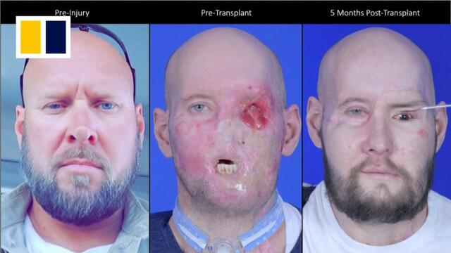 US surgeons perform world’s first eye transplant