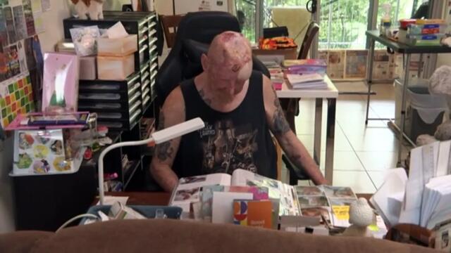 Researches say cannabis has 'deadly' effect on melanoma