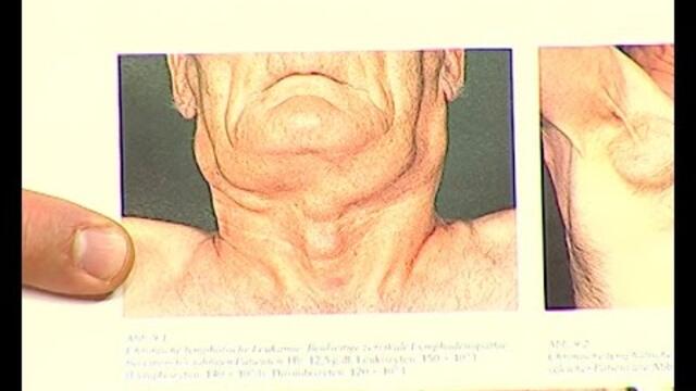 Лимфоми - видове диагностика и лечение