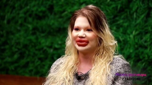 Българското Барби: Имам 12 инжекции в скулите и 10 в брадичката. Устните ми са уголемявани 38 пъти