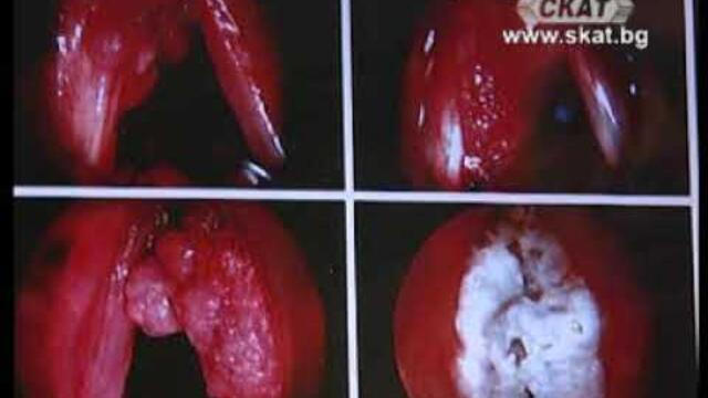 Тумори на ларинкса и назофаринкса. Ранна диагностика, профилактика и лечение