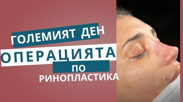 Големият ден операцията ми по Ринопластика