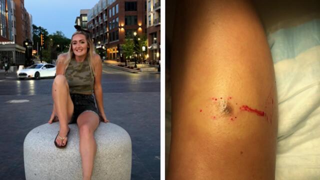 Young Woman's Tanning 'Addiction' Leads to Cancer Diagnosis