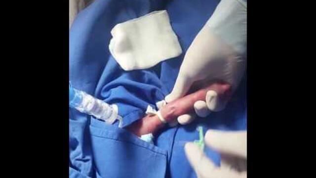 Cateter percutaneo bilumen