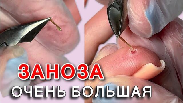 ЗАНОЗА БЫЛА ВНУТРИ 5 ДНЕЙ 🫢 ОНА ТЕПРЕЛА «до маникюра» как достать занозу кусачками? Заноза в пальце