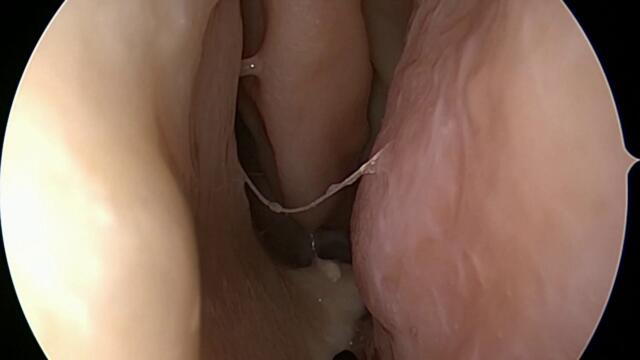 Nasal Endoscopic Exam