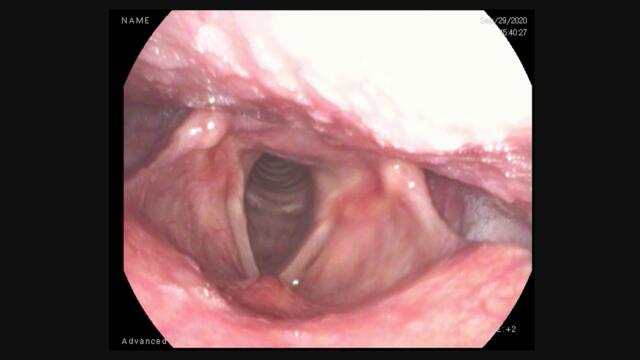 Flexible Laryngoscopy