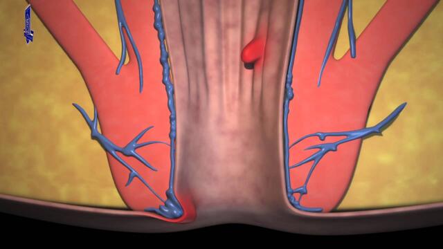 Хемороидална болест - лечение