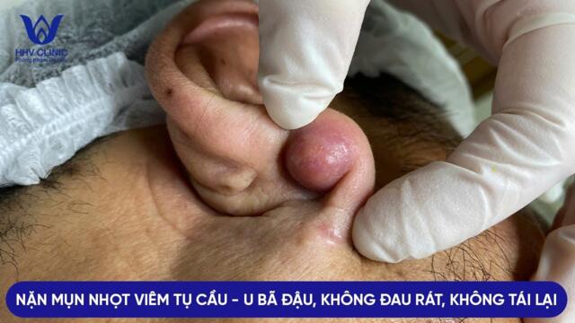 ĐIỀU TRỊ MỤN NHỌT VIÊM TỤ CẦU - MỤN U BÃ ĐẬU Ở VÀNH TAI, MỌC CŨNG 1 CHỖ THẬT LÀ BẤT NGỜ.