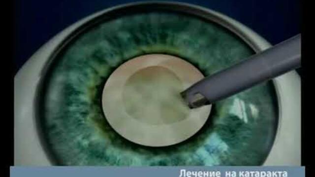 Лечение на катаракта