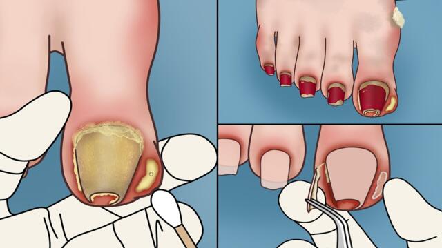 ASMR Cleanly Treat Old Ingrown Toenails and Pus! Strong Satisfaction!  | Deep Clean Treatment