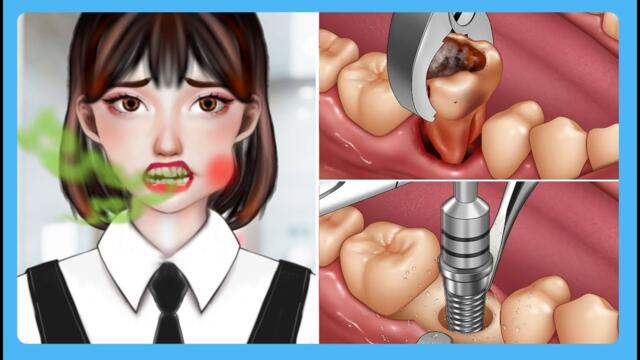 ASMR Severe Tooth Decay Implant Placement Process Animation | Teeth Whitening, Cavity Treatment
