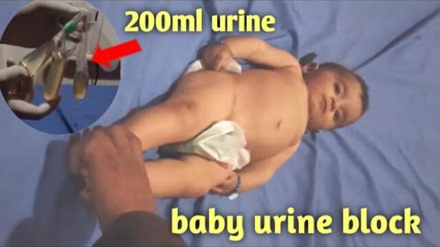 pass urine catheter, baby urinary retention, catheterization,