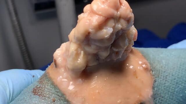 T6 Sharp Ingrown Trimmed! Professional Pedicure DR LEE’S with black mud and fungus X27030992