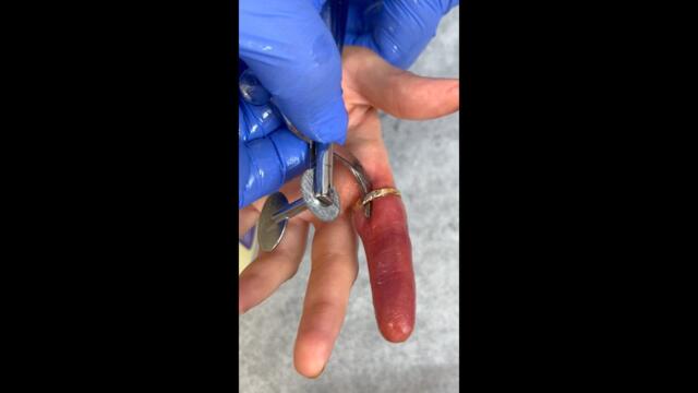 ¡Así es como un médico quitaría un anillo atascado! 💍