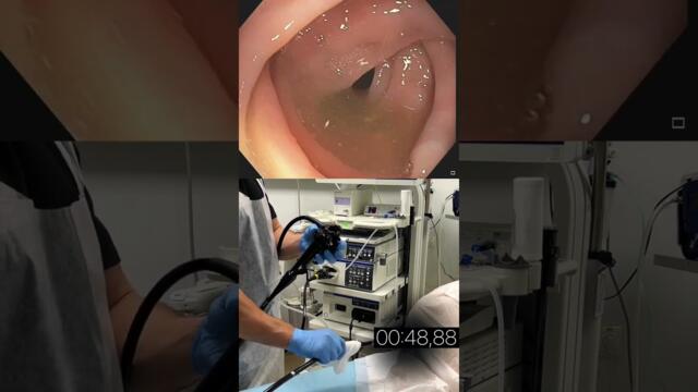 Колоноскопия