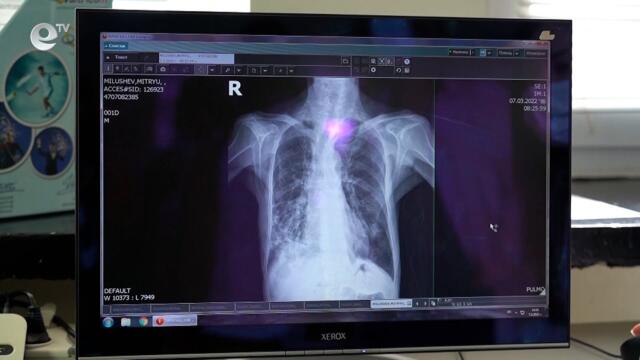 Едва 21 души се възползваха от безплатните прегледи за туберкулоза в Кърджали