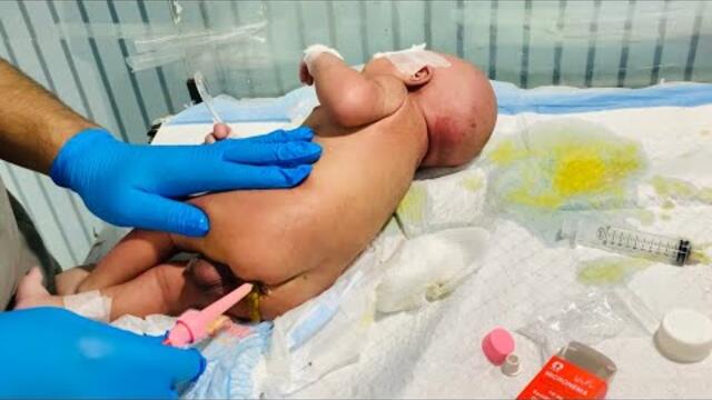 Newborn Baby Abdominal Distension Relief 💨 | Safe Use of Micronema for Gas & Constipation.