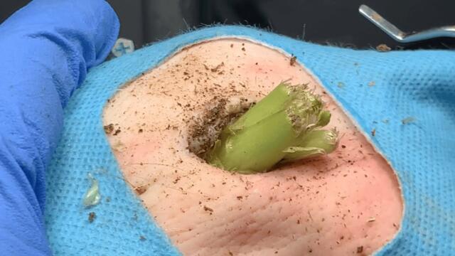 TLC DR LEE’S ULTIMATE ZITPOPPER / with Tweezer とんでもなく嬉しいことが起きたので報告します X181905 1730