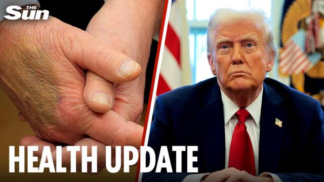 Donald Trump diagnosed with chronic condition after suffering 'swelling & bruising'
