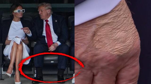 What Is That Spot on President Trump's Hand?