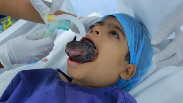 Giant Facial Hemangioma in a Child – Surgery Day Anesthesia