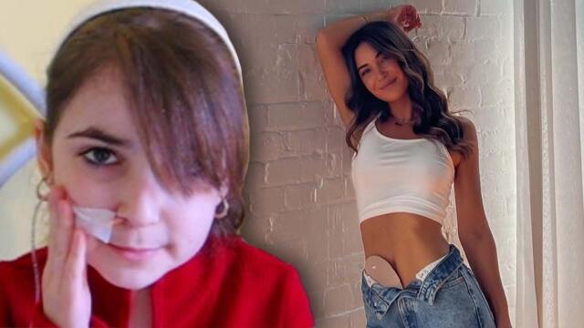 Model Kept Ostomy Bag a Secret for Years
