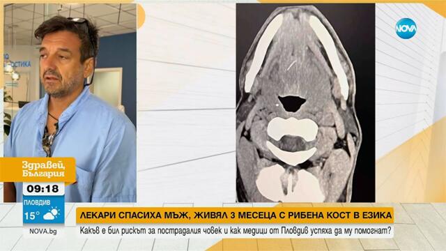Какъв е бил рискът за мъжа, живял 3 месеца с рибена кост в езика? - Здравей, България (18.08.2025)