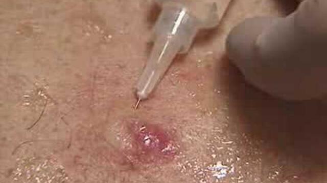 Injection of Local Anesthetic