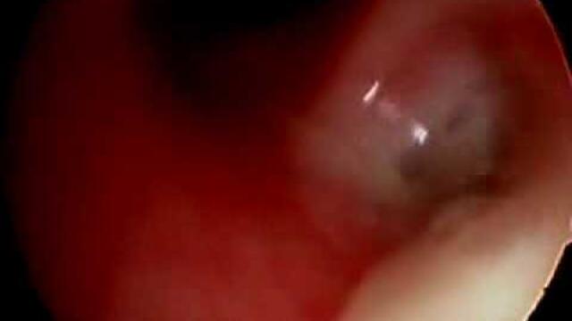 Rigid Bronchosopy - Right Pneumonia