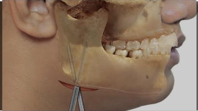 step by step incision and drainage of odontogenic infection. Two cases by Dr. Elshamaa