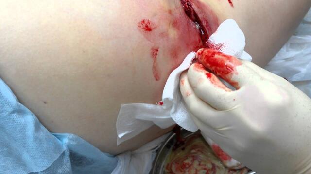 Вскрытие флегмоны, образовавшейся при нагноении атеромы.