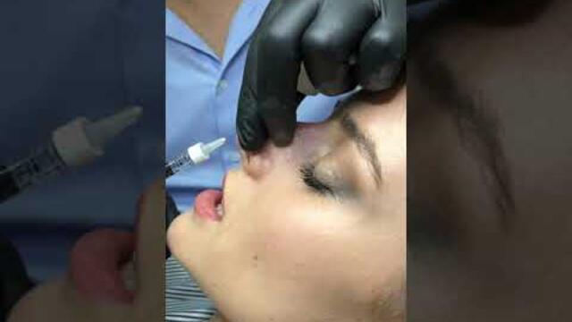 Burun dolgusu ile ameliyatsız değişim😊