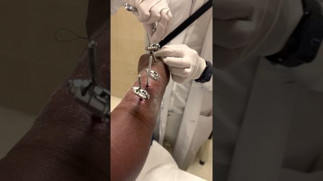 Retiro de fijadores externos en fractura de muñeca como retirar fijadores reduccion abierta mixta