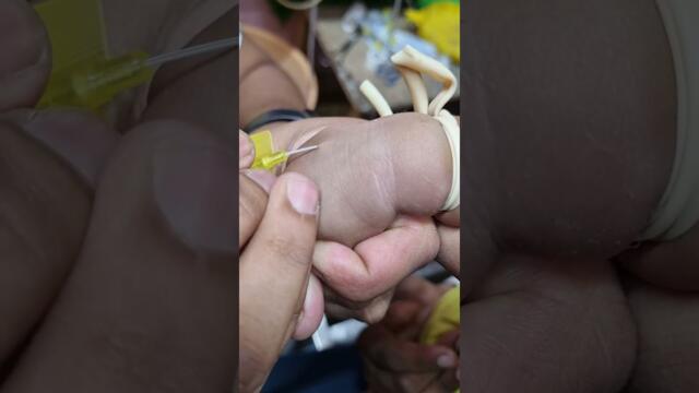 how to intravenous cannulation for 6 months child #ivcannulation #baby #viral #ivinsertion