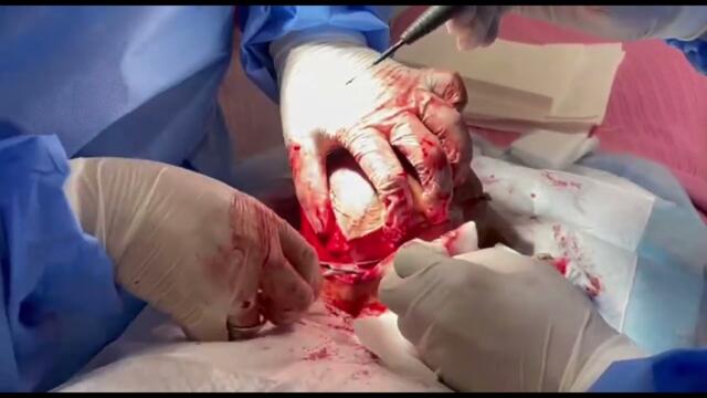 GIANT SEBACEOUS CYST