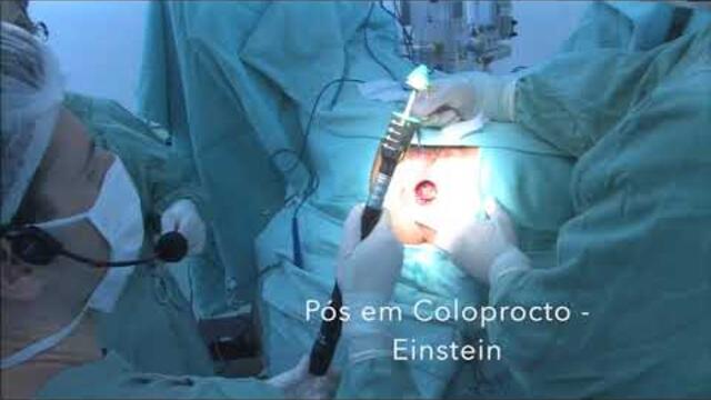 Hemorroidopexia por grampeamento (PPH) / Stapled hemorrhoidopexy