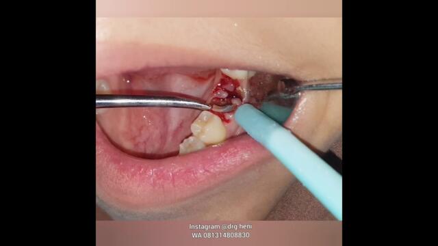 cabut sisa akar gigi || drg heni