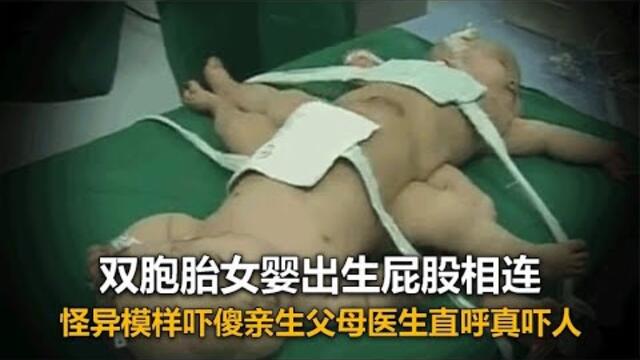 雙胞胎女嬰出生下體相連，怪異模樣嚇壞父母，醫生直呼根本沒見過 #尋寶 #古墓 #文物 #考古發現 #揭秘