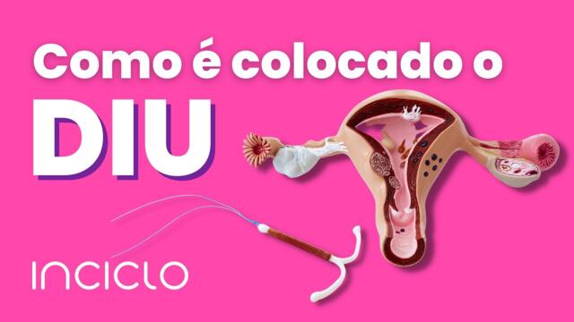 Como é Colocado o Diu - Como Funciona a Colocação do Diu