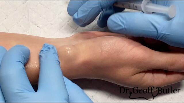 Drainage of a ganglion cyst and secondary injection of a steroid